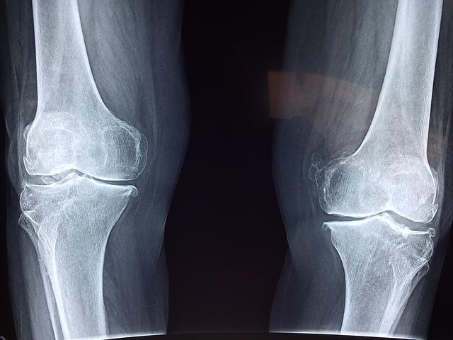 Knee radiograph: left and right knees with visible joint surfaces and tibia–femur alignment.